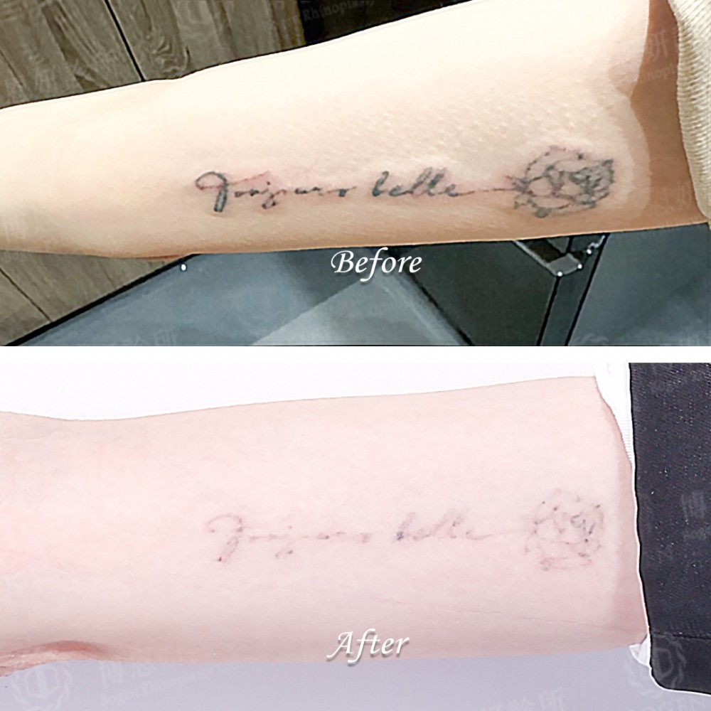 皮秒雷射除刺青,皮秒除刺青,除刺青,博恩妍